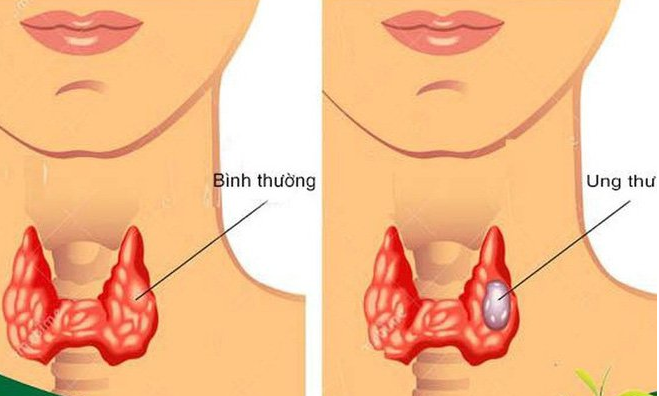 Hình ảnh ung thư tuyến giáp