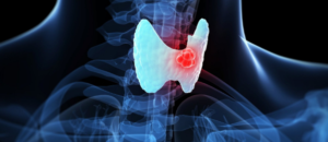 Xét nghiệm Anti-Tg kết hợp với Tg để theo dõi tình trạng bệnh sau phẫu thuật điều trị ung thư