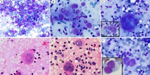 Tế bào Reed –Sternberg trong U lympho ác tính Hodgkin