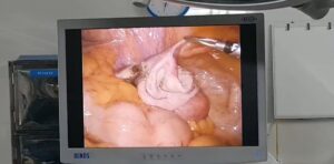 Hình ảnh U nang buồng trứng kích thước lớn 7cm tại BVĐK Hồng Hà