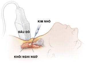 Xét nghiệm tế bào học bằng chọc hút kim nhỏ