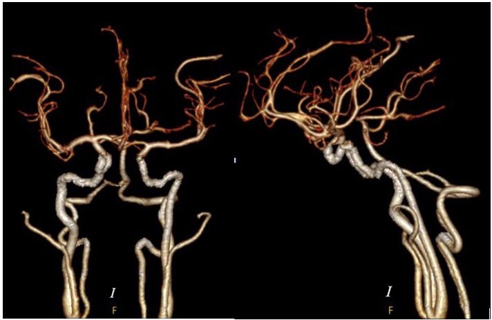 Hình ảnh mạch máu não